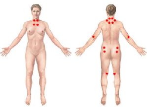fibromyalgie